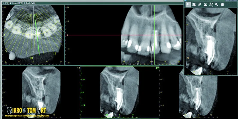 Kontrolne CBCT po zabiegu — szczelne wypełnienie kanału i stan po resekcji wierzchołka
