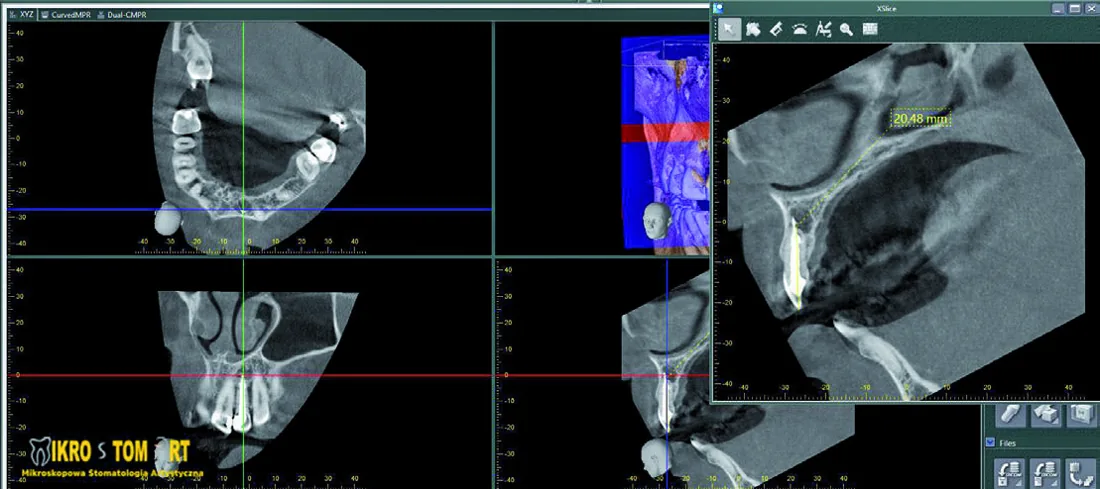 Wyjściowe badanie CBCT — ząb 22 z przewlekłym stanem zapalnym i materiałem poza wierzchołkiem