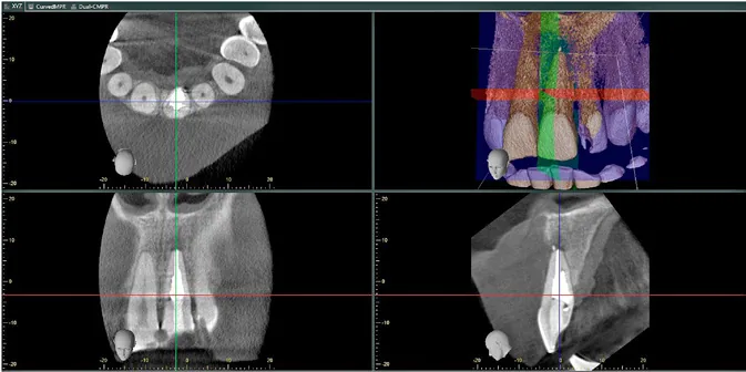 Kontrolne badanie CBCT po leczeniu — wypełniony kanał i postępująca odbudowa kości