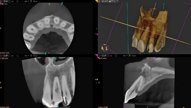 Badanie CBCT przed leczeniem — inwazyjna resorpcja przyszyjkowa zęba 21 ze zmianą okołowierzchołkową