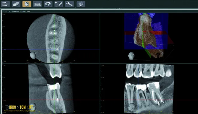 Kontrolne badanie CBCT 9 miesięcy po leczeniu — gojenie tkanek okołowierzchołkowych