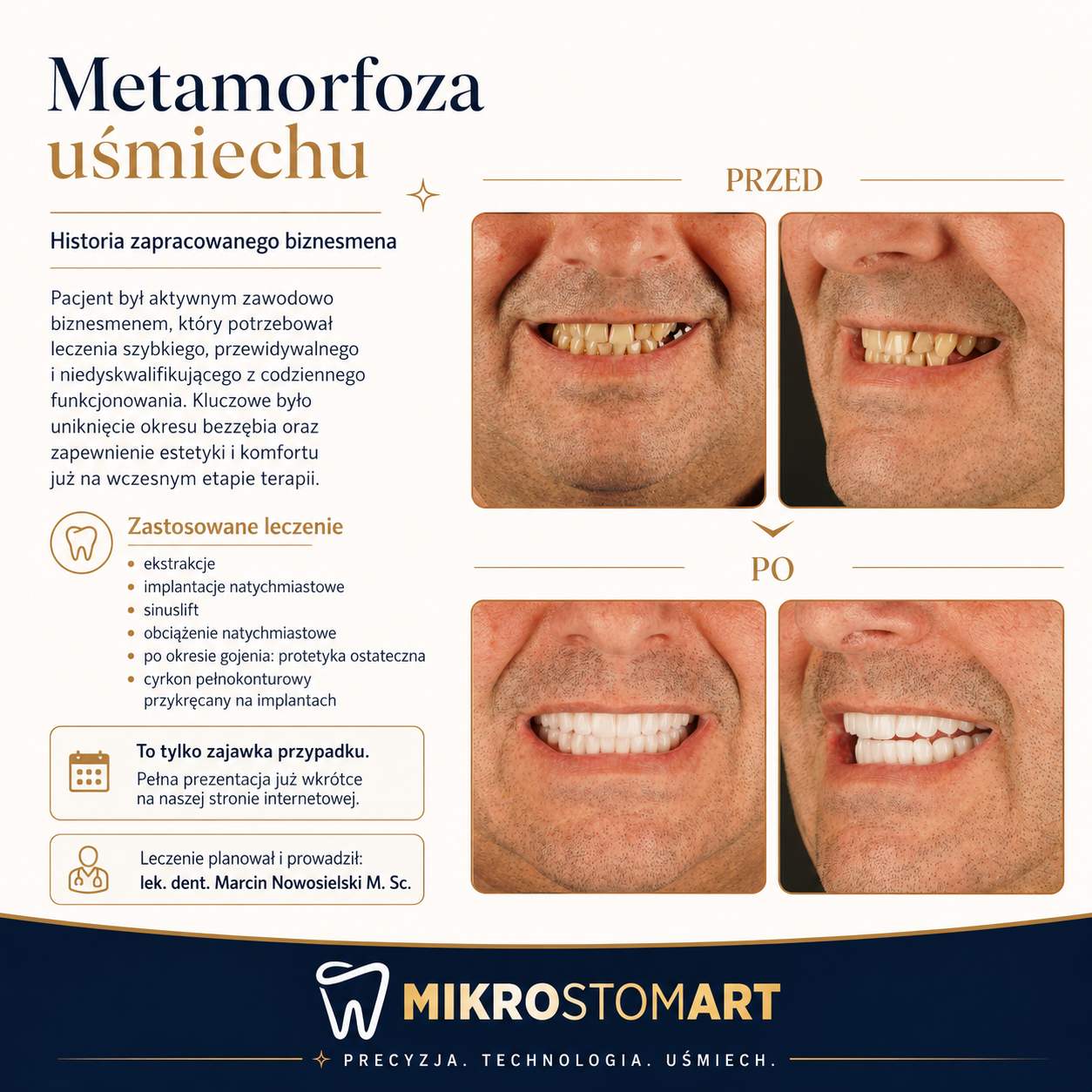 Pełna rekonstrukcja na implantach — przed i po, case z kliniki Mikrostomart Opole